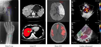 machine learning in medical imaging